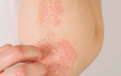 ¿Qué es la psoriasis?