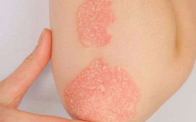 Causas de la Psoriasis