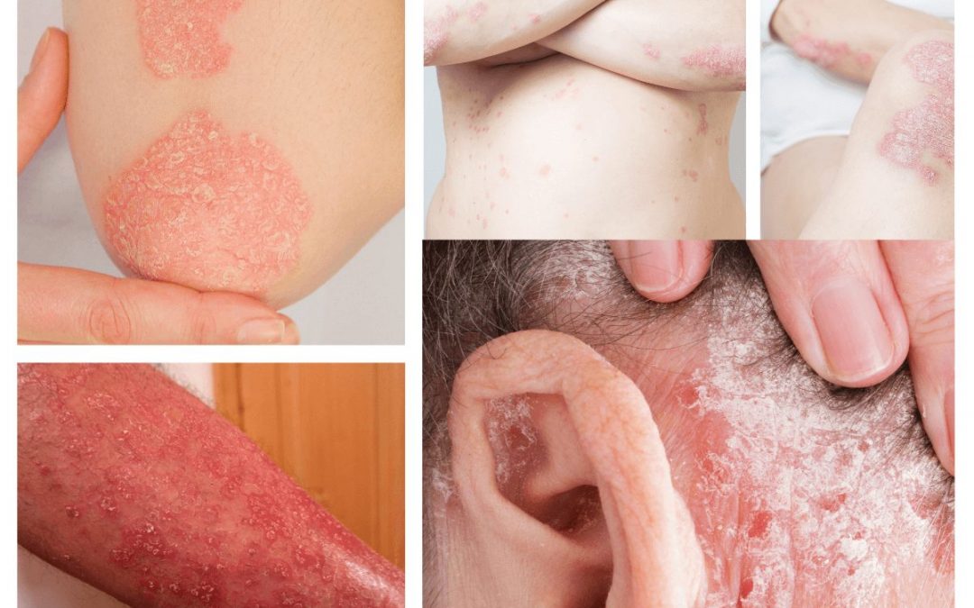 Tipos de Psoriasis